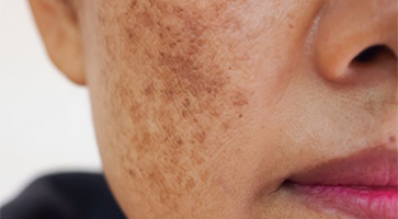 Melasma.jpg