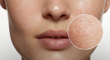 Open-Pores-Treatment.jpg